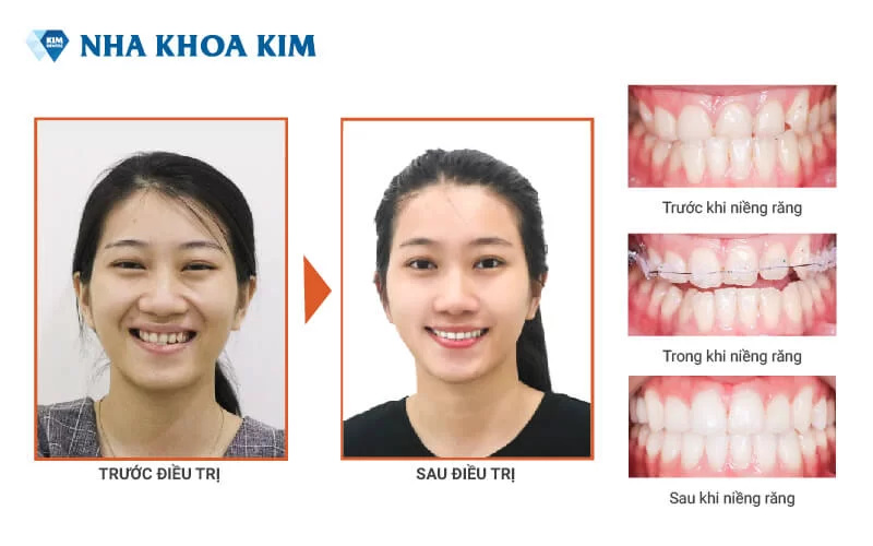 Khách hàng niềng răng mắc cài sứ