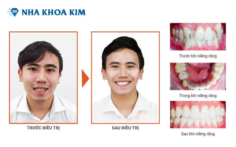 Khách hàng niềng răng mặt trong (mặt lưỡi)