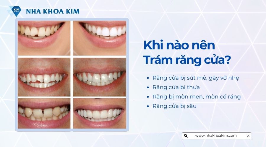 Khi nào nên trám răng cửa