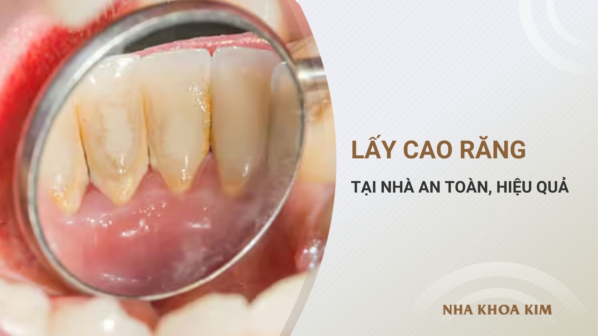 Hướng dẫn lấy cao răng tại nhà an toàn, hiệu quả
