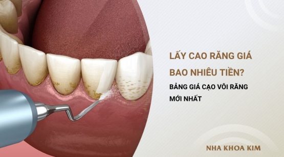 Lấy cao răng giá bao nhiêu tiền? Bảng giá cạo vôi răng 2025