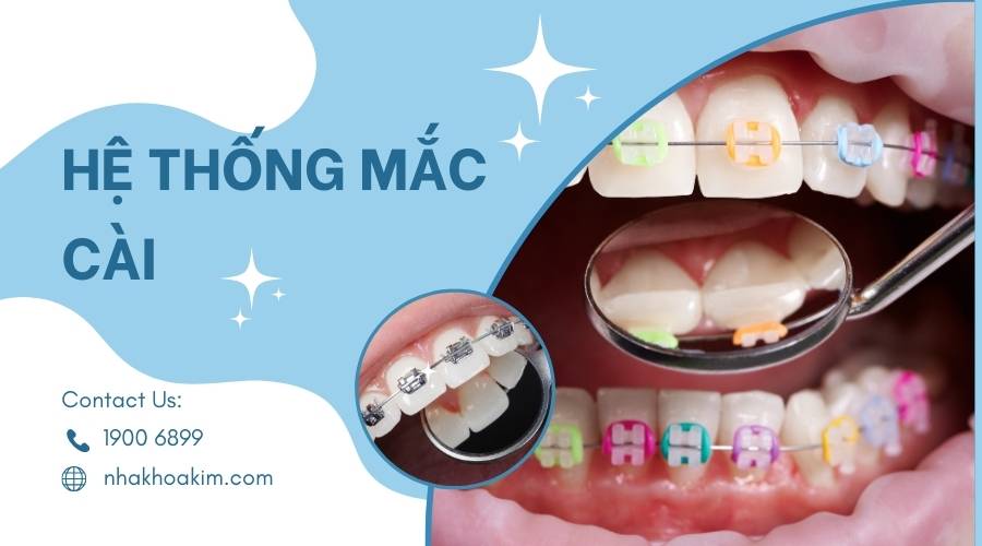 Hệ thống mắc cài