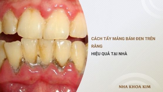 Cách tẩy mảng bám đen trên răng hiệu quả tại nhà