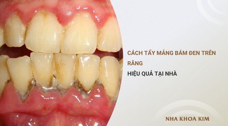 Cách tẩy mảng bám đen trên răng hiệu quả tại nhà