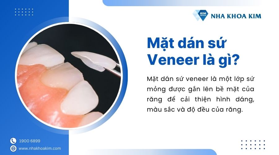mặt dán sứ veneer là gì