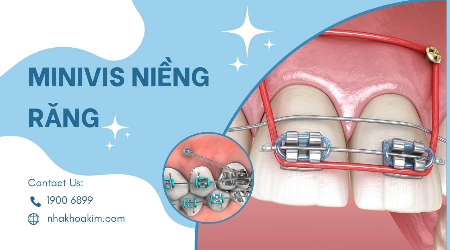 Minivis niềng răng