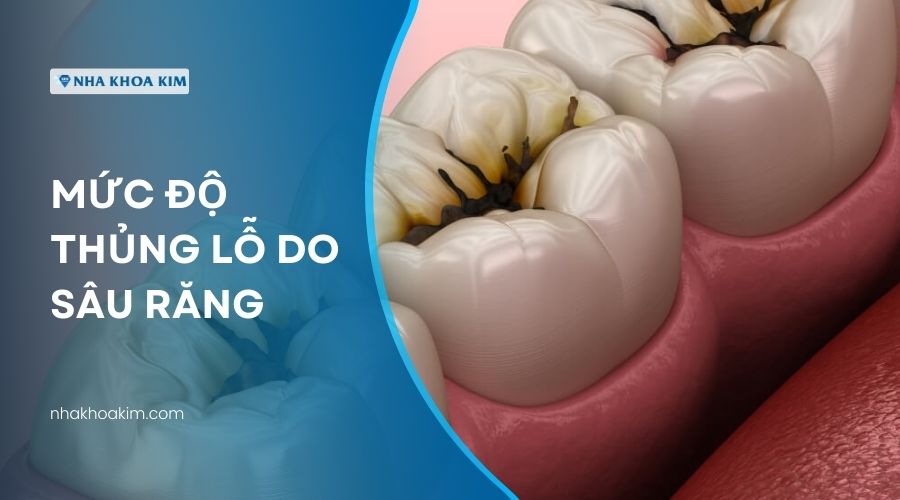 Xác định mức độ răng bị thủng lỗ do sâu răng