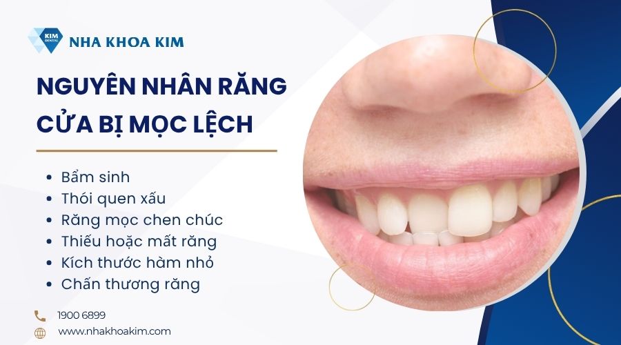 Nguyên nhân răng cửa bị mọc lệch