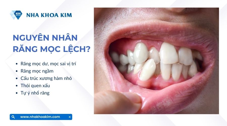 nguyên nhân răng mọc lệch lạc