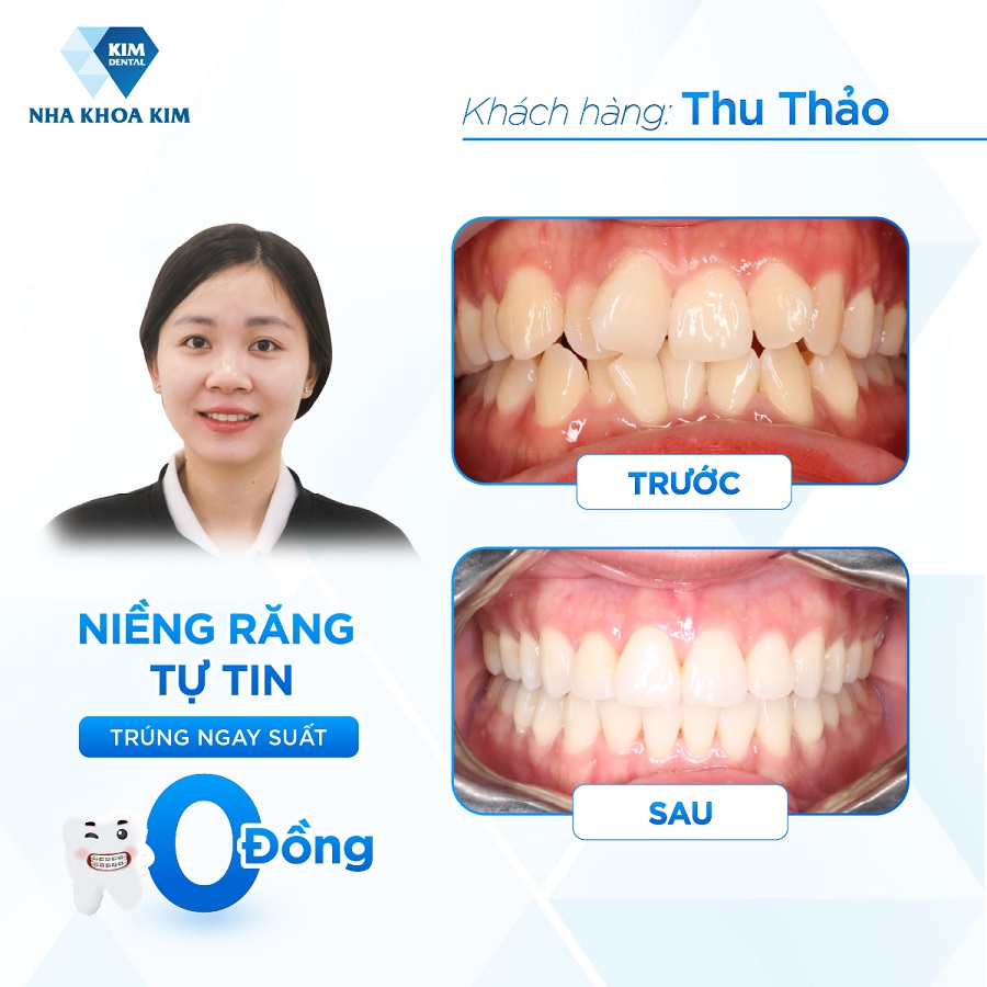 Hình ảnh khách hàng trước - sau khi tới với Nha Khoa Kim Hà Nội