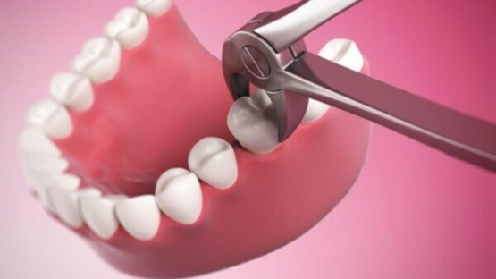 Nhổ răng khôn hàm dưới có nguy hiểm sức khỏe không?