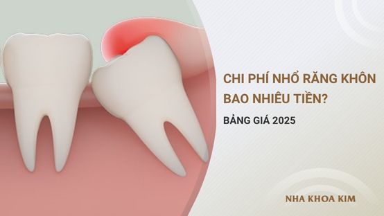 Chi phí nhổ răng khôn bao nhiêu tiền? Bảng giá 2025