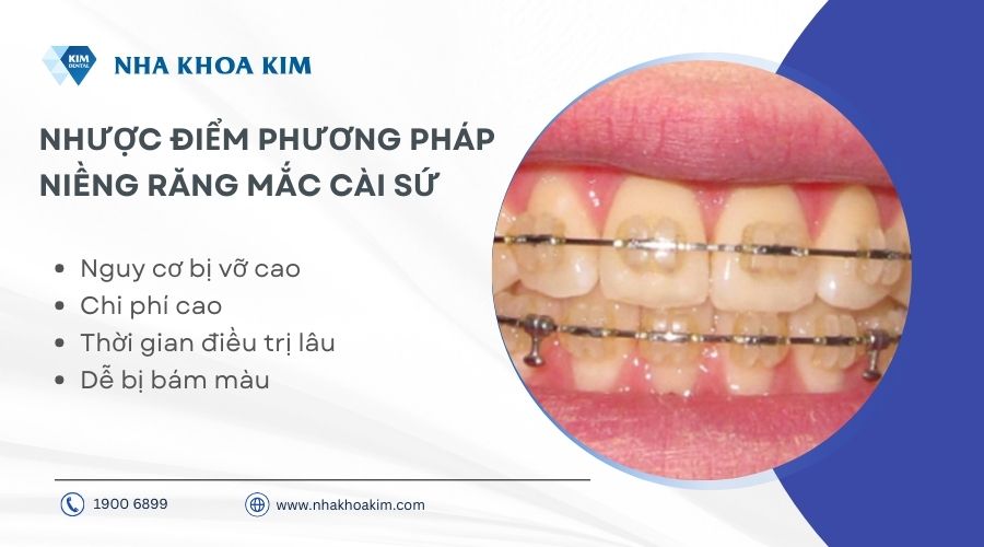 Nhược điểm niềng răng mắc cài sứ