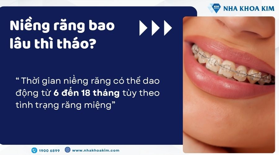 Niềng răng bao lâu thì tháo?