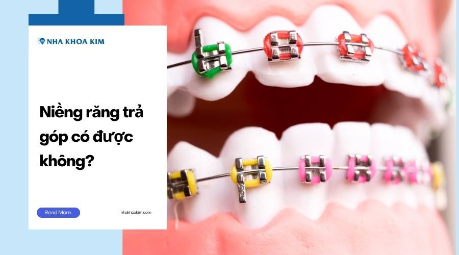 Niềng răng trả góp có được không?