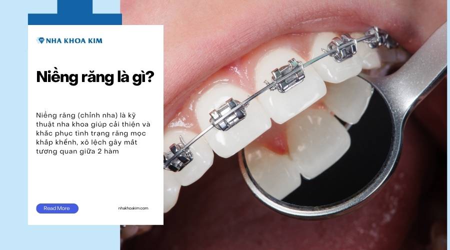 Niềng răng là gì?