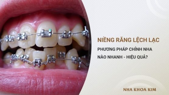 Niềng răng lệch lạc – Loại nào nhanh và hiệu quả nhất?