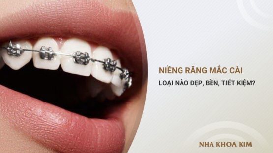 Các loại mắc cài niềng răng hiện nay – Bạn đã biết chưa?