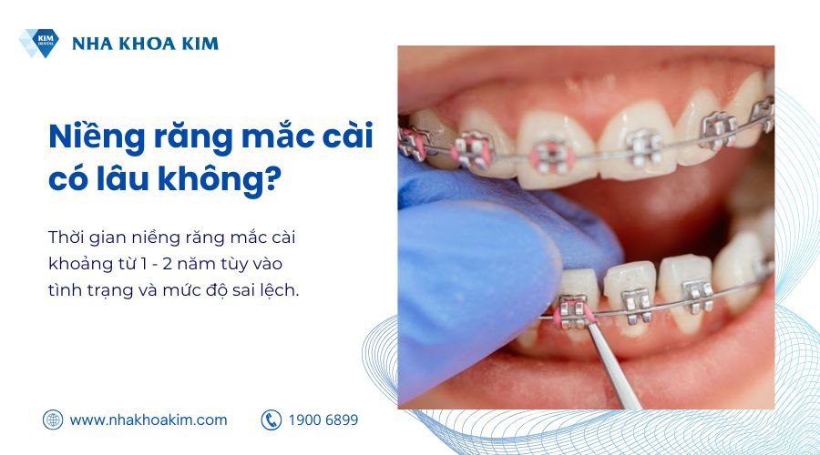niềng mắc cài có lâu không