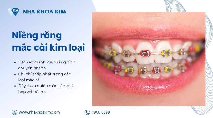 niềng mắc cài kim loại