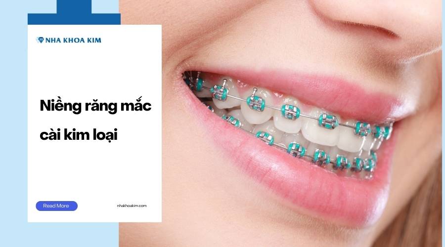 Niềng răng mắc cài kim loại