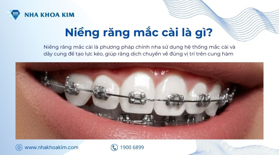 niềng răng mắc cài là gì