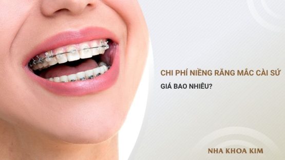 Chi Phí Niềng Răng Mắc Cài Sứ Giá Bao Nhiêu?