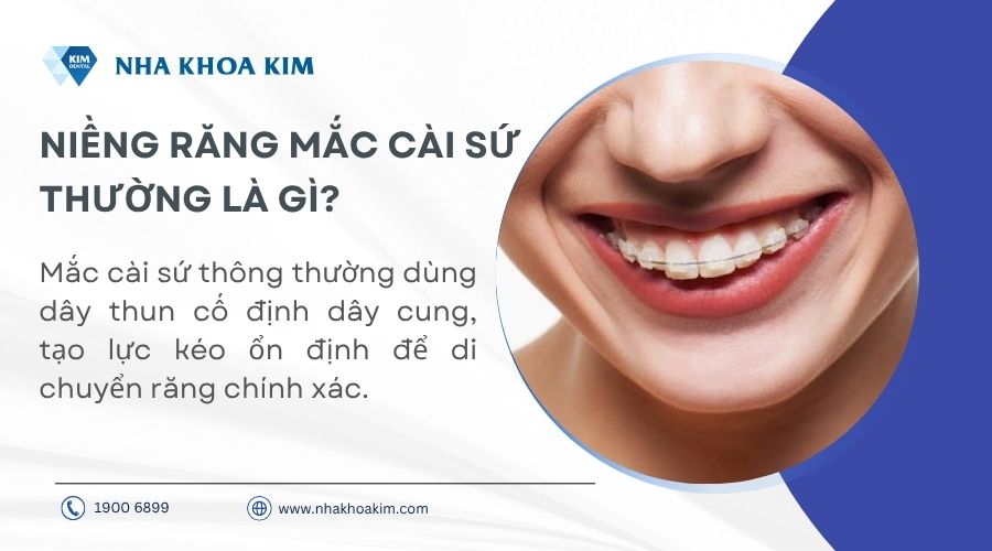 Niềng răng mắc cài sứ thường