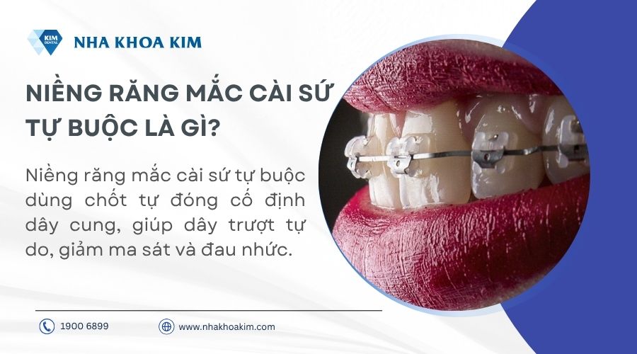 Niềng răng mắc cài sứ tự buộc