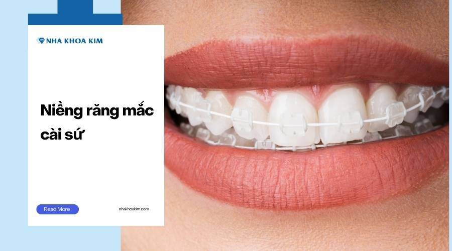 Niềng răng mắc cài sứ