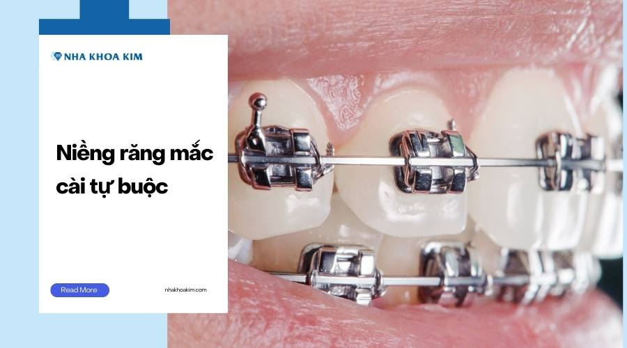 Niềng răng mắc cài tự buộc