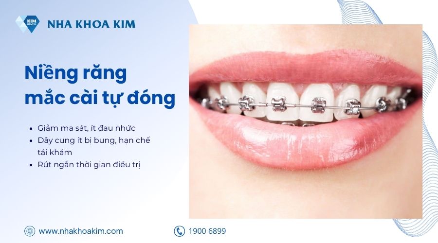niềng mắc cài tự đóng