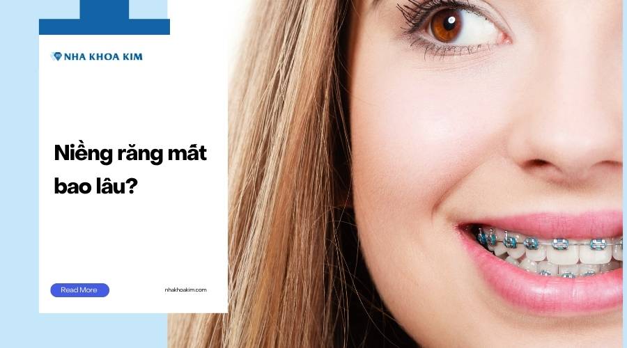 Niềng răng mất bao lâu?