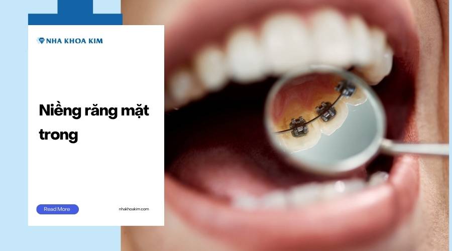 Niềng răng mặt trong (mặt lưỡi)