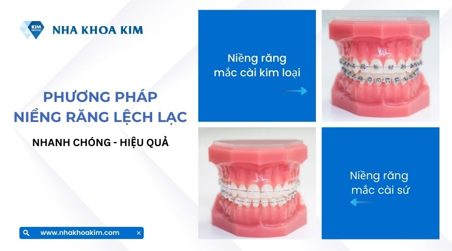 niềng răng lệch lạc hiệu quả bằng niềng răng mắc cài