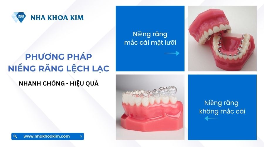 niềng răng lệch lạc bằng phương pháp niềng không mắc cài