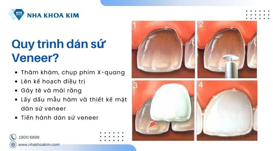 quy trình dán sứ veneer