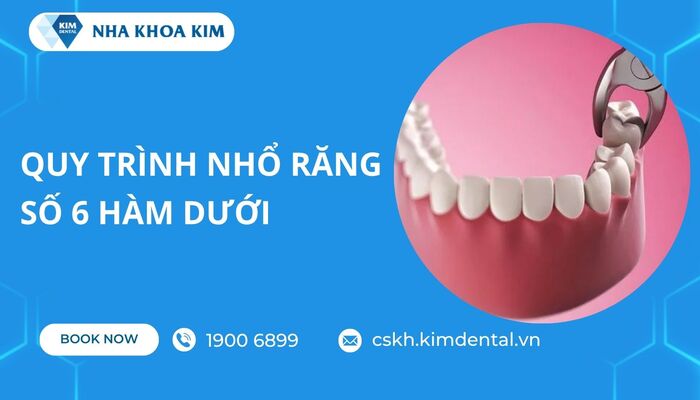 quy trình nhổ răng số 6 