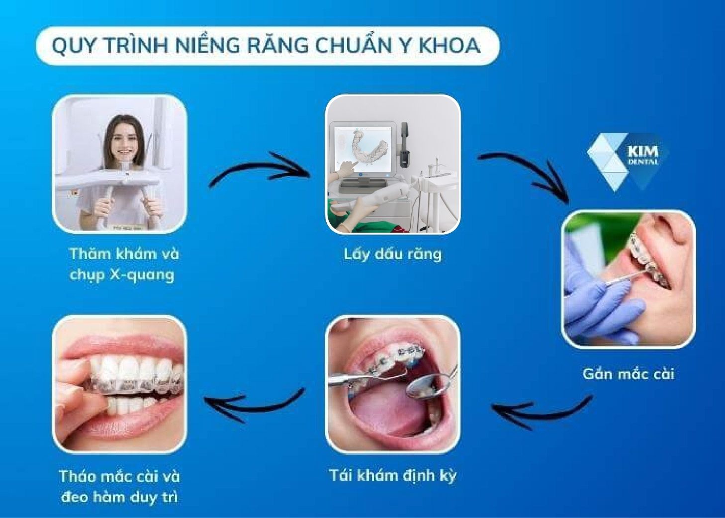 Quy trình niềng răng chuẩn Y khoa tại Nha Khoa Kim