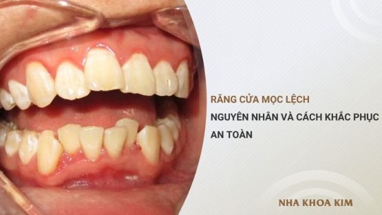 Răng cửa mọc lệch: Nguyên nhân và cách khắc phục an toàn