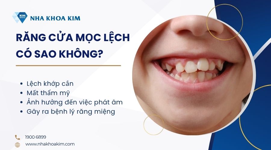 Răng cửa mọc lệch có sao không?