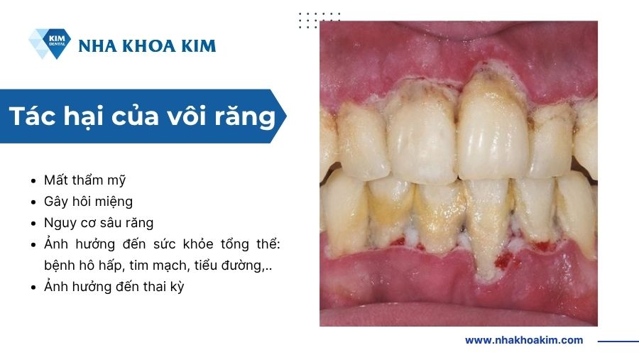Tác hại của vôi răng