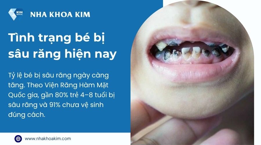 Tình trạng bé bị sâu răng hiện nay