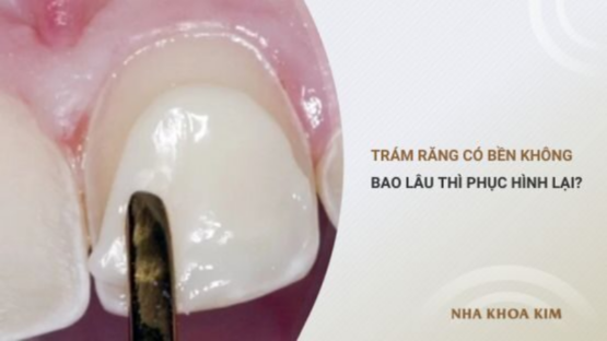 Trám răng có bền không? Bao lâu thì phục hình lại?