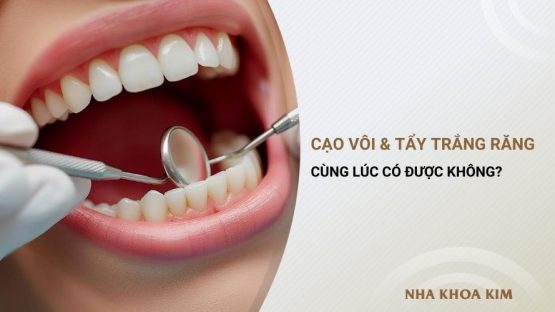 Cạo vôi răng và tẩy trắng răng cùng lúc có được không?