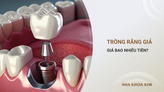 Giá làm răng giả khoảng bao nhiêu tiền? Thông tin chi tiết