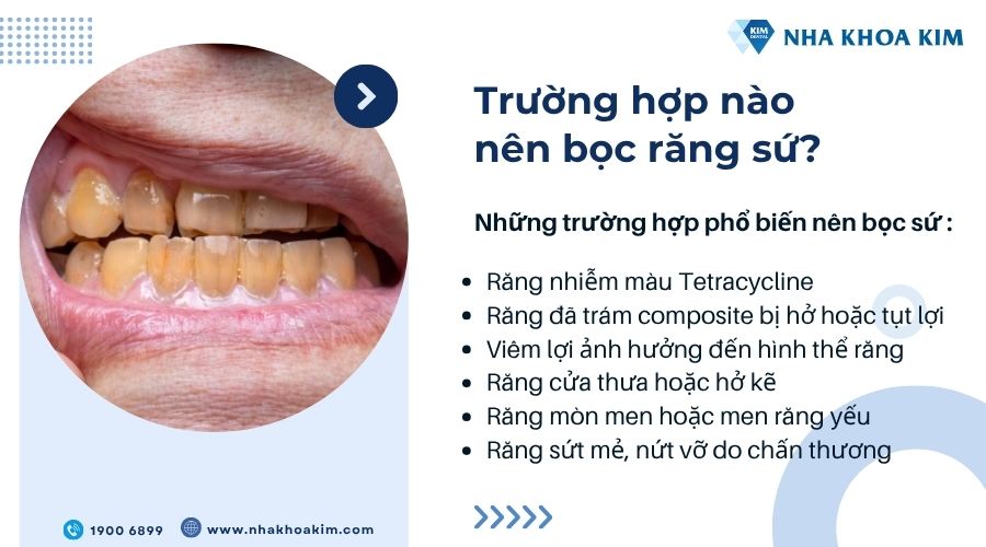 Trường hợp nào nên bọc răng sứ?