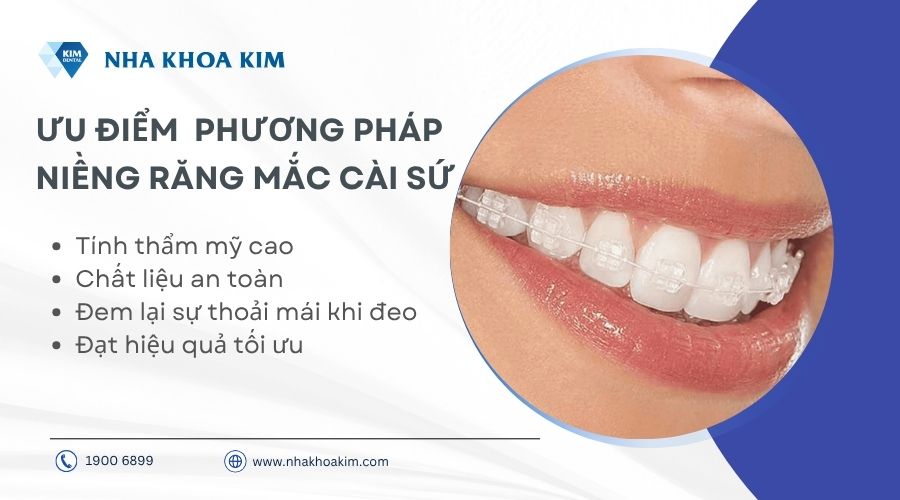 Ưu điểm phương pháp niềng răng mắc cài sứ