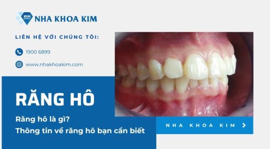 Răng hô là gì? Thông tin về răng hô bạn cần biết