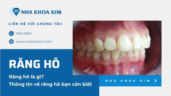 Răng hô là gì? Thông tin về răng hô bạn cần biết